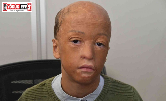 Araç yangınında yüzü yanan sekiz yaşındaki Halil yardım bekliyor